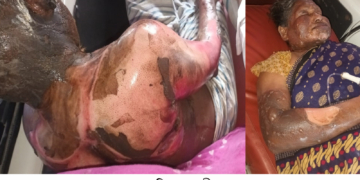 সাঁথিয়ায় এক দম্পতিকে পুড়িয়ে হত্যাচেষ্টা